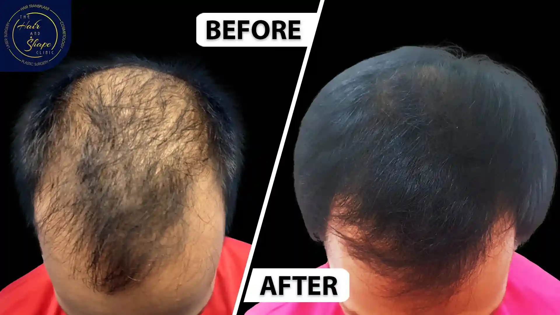 PRP Treatment result6